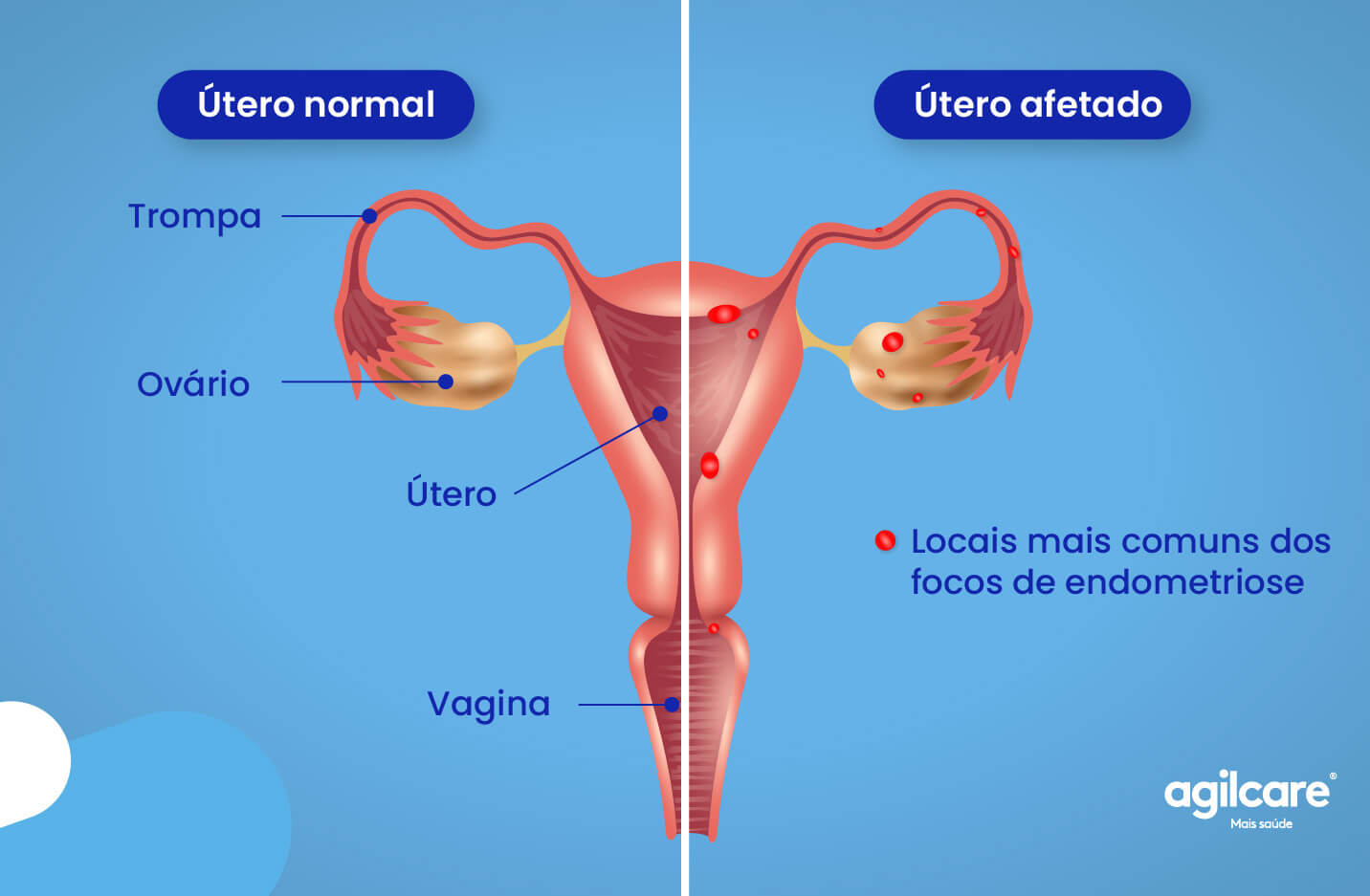 endometriose 